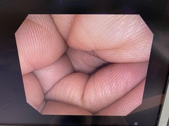 大腸ビデオスコープ｜PCF-Q150AI｜オリンパスメディカルシステムズ株式会社の写真6枚目