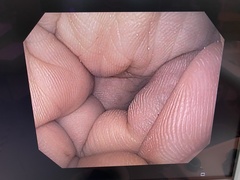 Video Gastroscope｜GIF-Q150X｜Olympus Medical Systems photo6