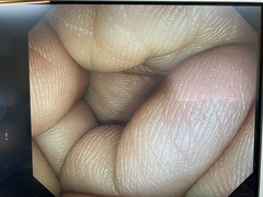 大腸ビデオスコープ｜PCF-H290TI｜オリンパスメディカルシステムズ株式会社の写真6枚目