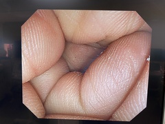 大腸ビデオスコープ｜PCF-Q260AI｜オリンパスメディカルシステムズ株式会社の写真6枚目