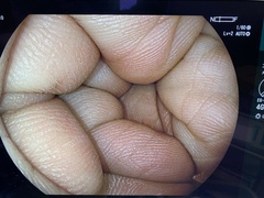 下部消化管用拡大スコープ｜EC-L600ZW7｜富士フイルムメディカルの写真6枚目