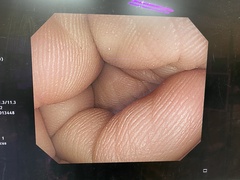 大腸ビデオスコープ｜PCF-Q260AI｜オリンパスメディカルシステムズ株式会社の写真6枚目