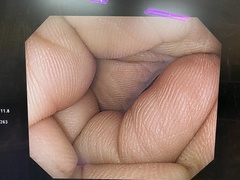大腸ビデオスコープ｜PCF-Q260AZI｜オリンパスメディカルシステムズ株式会社の写真6枚目