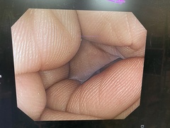 大腸ビデオスコープ｜PCF-Q260AZI｜オリンパスメディカルシステムズ株式会社の写真6枚目