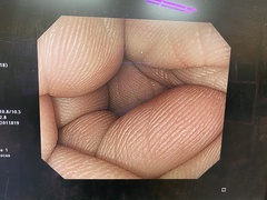 上部消化管汎用ビデオスコープ｜GIF-H260Z｜オリンパスメディカルシステムズ株式会社の写真6枚目