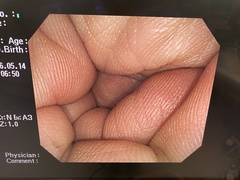 大腸ビデオスコープ｜PCF-Q260AI｜オリンパスメディカルシステムズ株式会社の写真6枚目