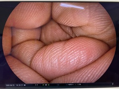 上部消化管用経鼻スコープ｜EG-580NW｜富士フイルムメディカルの写真6枚目