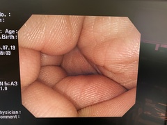 Video Colonoscope｜PCF-Q260AI｜Olympus Medical Systems photo6