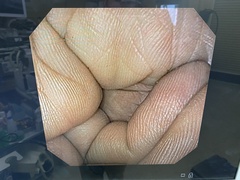 上部消化管経鼻スコープ｜GIF-XP170N｜オリンパスメディカルシステムズ株式会社の写真6枚目