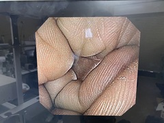 上部消化管経鼻スコープ｜GIF-XP170N｜オリンパスメディカルシステムズ株式会社の写真6枚目