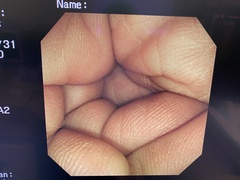 大腸ビデオスコープ｜CF-240AI｜オリンパスメディカルシステムズ株式会社の写真6枚目