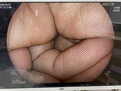 下部消化管用拡大スコープ｜EC-L600ZP7｜富士フイルムメディカルの写真6枚目