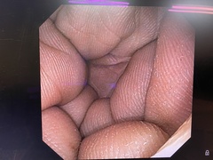 上部消化管経鼻スコープ｜GIF-XP170N｜オリンパスメディカルシステムズ株式会社の写真6枚目