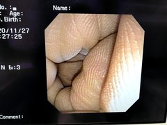 Video Transnasal Gastroscope｜GIF-XP150N｜Olympus Medical Systems photo7