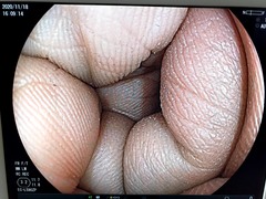 Video Colonoscope｜EC-L590ZP｜Fujifilm Medical photo7