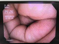 Video Colonoscope｜CF-V70I｜Olympus Medical Systems photo7