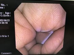 Video Transnasal Gastroscope｜GIF-XP150N｜Olympus Medical Systems photo7