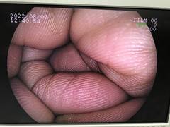 Video Gastroscope｜EG-250WR5｜Fujifilm Medical photo7