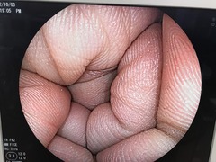 大腸ビデオスコープ｜EC-590WM3｜富士フイルムメディカルの写真7枚目