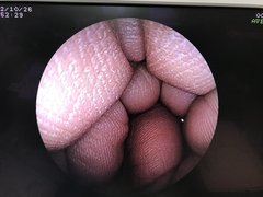 Video Gastroscope｜EG-250PE5｜Fujifilm Medical photo7
