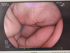 Video Colonoscope｜EC-590ZP｜Fujifilm Medical photo7