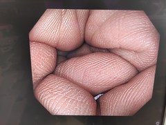 大腸ビデオスコープ｜CF-H290I｜オリンパスメディカルシステムズ株式会社の写真7枚目