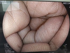下部消化管用拡大スコープ｜EC-L600ZP7｜富士フイルムメディカルの写真7枚目