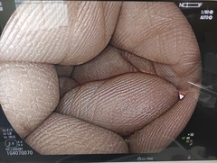 上部消化管用拡大スコープ｜EG-L600ZW7｜富士フイルムメディカルの写真7枚目