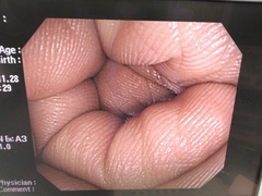 大腸ビデオスコープ｜CF-Q260AI｜オリンパスメディカルシステムズ株式会社の写真7枚目