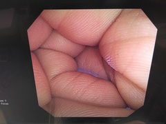 Video Colonoscope｜PCF-P240AI｜Olympus Medical Systems photo7