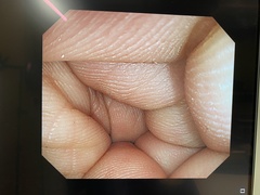 大腸ビデオスコープ｜PCF-Q260AI｜オリンパスメディカルシステムズ株式会社の写真7枚目