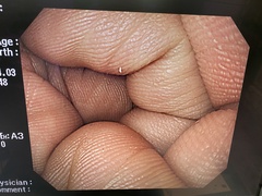 上部消化管汎用ビデオスコープ｜GIF-H260｜オリンパスメディカルシステムズ株式会社の写真7枚目