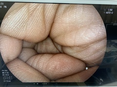 上部消化管細経スコープ｜EG-550WR｜富士フイルムメディカルの写真7枚目