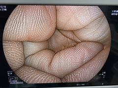 Video Transnasal Gastroscope｜EG-L580NW｜Fujifilm Medical photo7