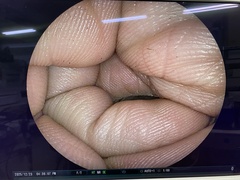 下部消化管用細径スコープ｜EC-590MP｜富士フイルムメディカルの写真7枚目