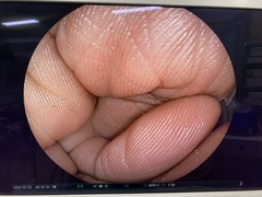 Video Colonoscope｜EC-590WM3｜Fujifilm Medical photo7