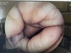 Video Colonoscope｜EC-3000MP｜Fujifilm Medical photo7