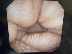 Video Bronchoscope｜BF-1T260｜Olympus Medical Systems photo7