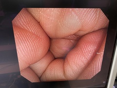 Video Colonoscope｜CF-H260AI｜Olympus Medical Systems photo7