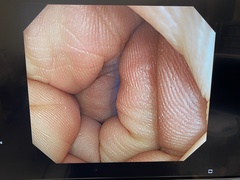 Video Colonoscope｜PCF-Q240ZI｜Olympus Medical Systems photo7