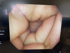 大腸ビデオスコープ｜PCF-H290ZI｜オリンパスメディカルシステムズ株式会社の写真7枚目