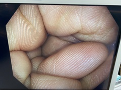 大腸ビデオスコープ｜PCF-H290I｜オリンパスメディカルシステムズ株式会社の写真7枚目