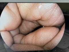 上部消化管用光学拡大スコープ｜EG-590ZW2｜富士フイルムメディカルの写真7枚目