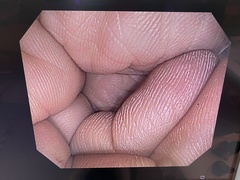 大腸ビデオスコープ｜PCF-Q150AI｜オリンパスメディカルシステムズ株式会社の写真7枚目