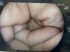 下部消化管用拡大スコープ｜EC-L600ZP7｜富士フイルムメディカルの写真7枚目