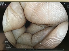 Video Colonoscope｜EC-L590ZP｜Fujifilm Medical photo8