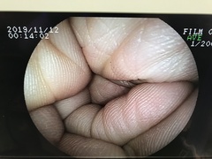 Video Colonoscope｜EC-250WM｜Fujifilm Medical photo8