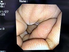 Video Transnasal Gastroscope｜GIF-XP150N｜Olympus Medical Systems photo8