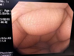 Video Colonoscope｜PCF-Q240ZI｜Olympus Medical Systems photo7