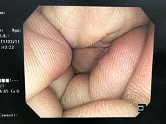 Video Colonoscope｜PCF-Q260AI｜Olympus Medical Systems photo7